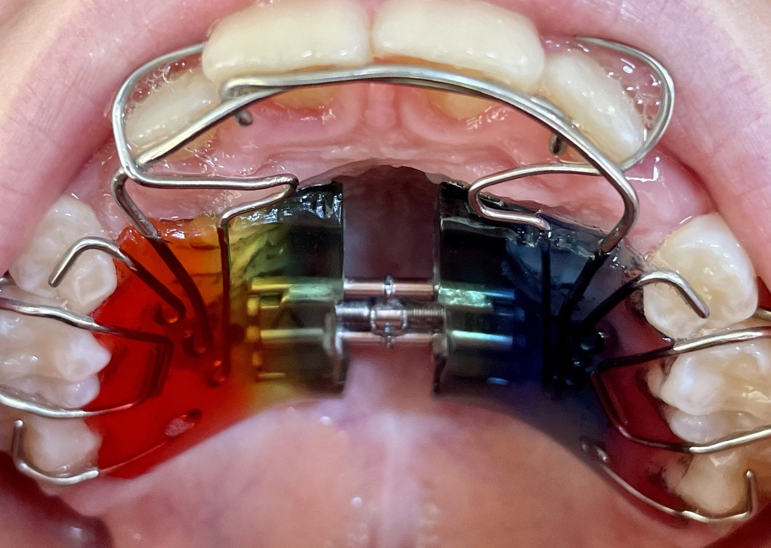Dental and Orthodontic Concerns — Spot On Orofacial Myology Clinic
